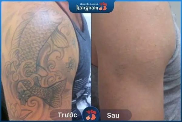 Xóa xăm tại Kangnam