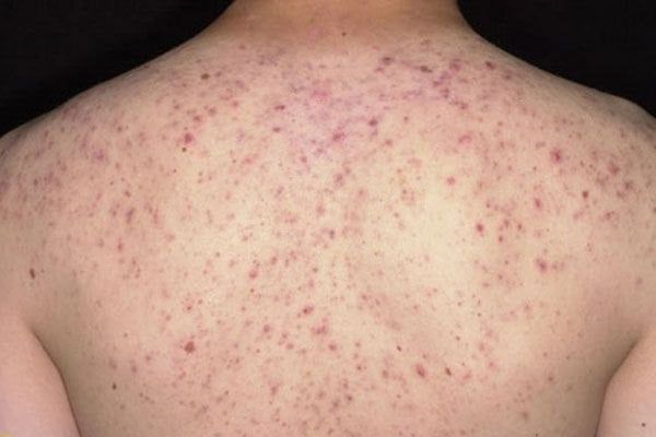 Khi nào mụn lưng là dấu hiệu cần lưu ý