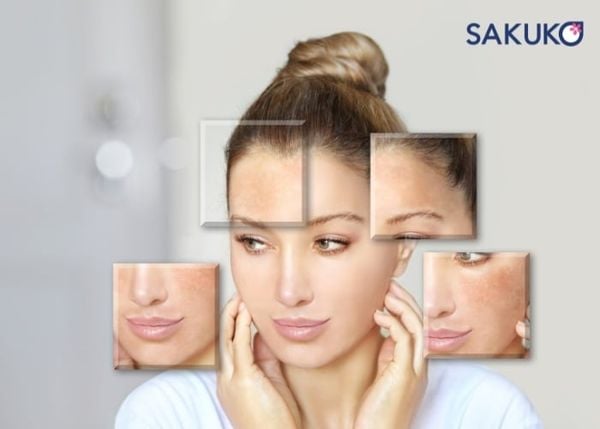 Nám da thường xuất hiện nhiều ở phần má