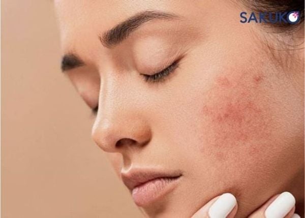 Bôi serum bị rát mặt có sao không?