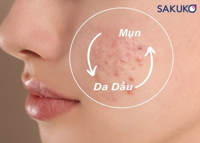 Vì sao kem dưỡng ẩm vẫn cần thiết cho da dầu mụn