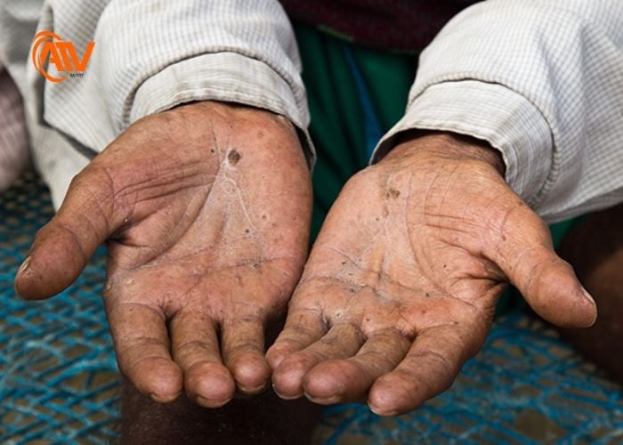 Sự cố ngộ độc hóa chất gây nguy hiểm