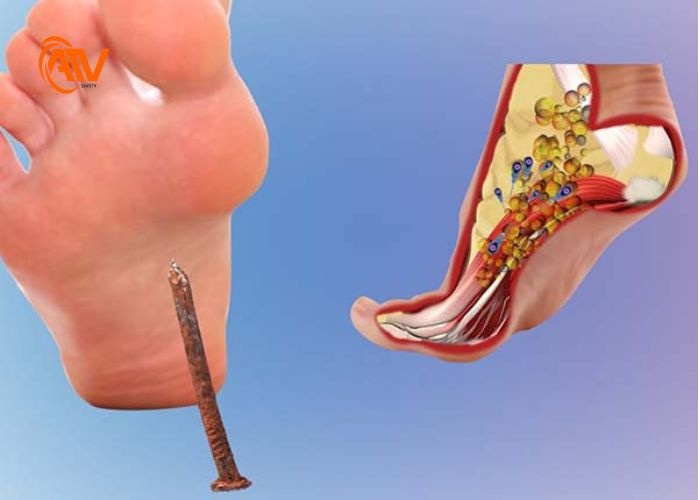 Nguyên nhân phổ biến gây ra bệnh uốn ván