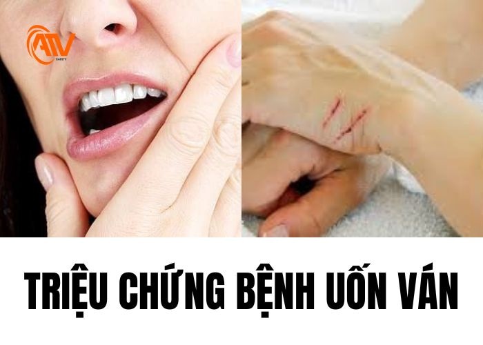 Biểu hiện bệnh uốn ván điển hình