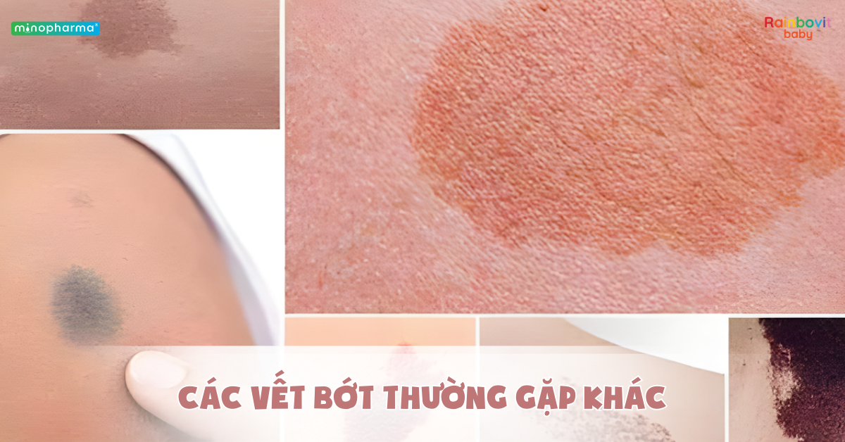 Các loại vết bớt thường gặp ở trẻ sơ sinh – khi nào bình thường, khi nào cần lo?