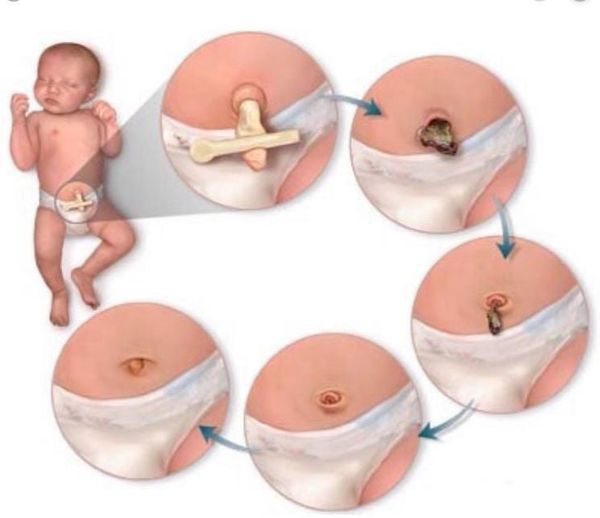 5 Bước Vệ Sinh Rốn Chuẩn Y Khoa