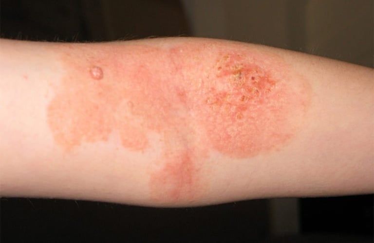 Chàm cấp là gì? (Acute eczema)