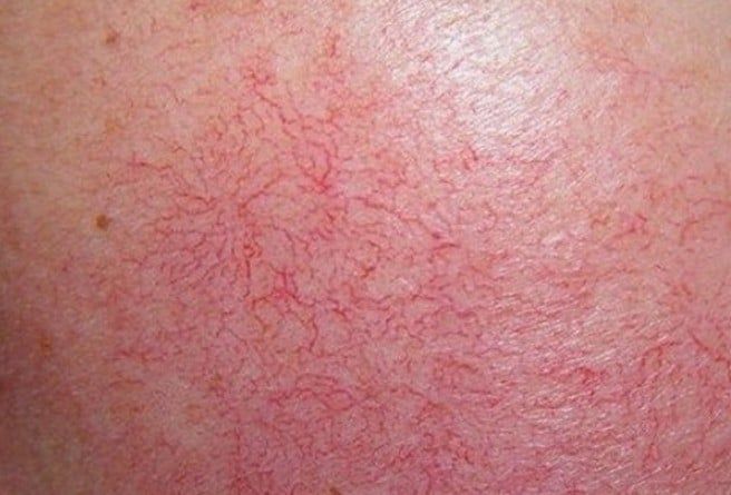 HỘI CHỨNG CAI CORTICOID LÀ GÌ? LÀM SAO BIẾT MÌNH BỊ?
