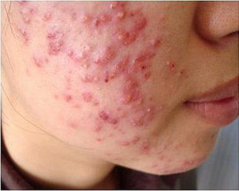 QUY TRÌNH PHỤC HỒI DA 3-6-12 THÁNG SAU KEM TRỘN