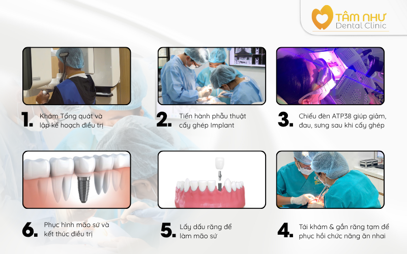 Quy trình cấy ghép Implant tại Nha khoa Tâm Như