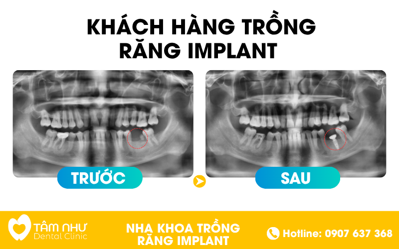 Trường hợp nào nên trồng răng Implant