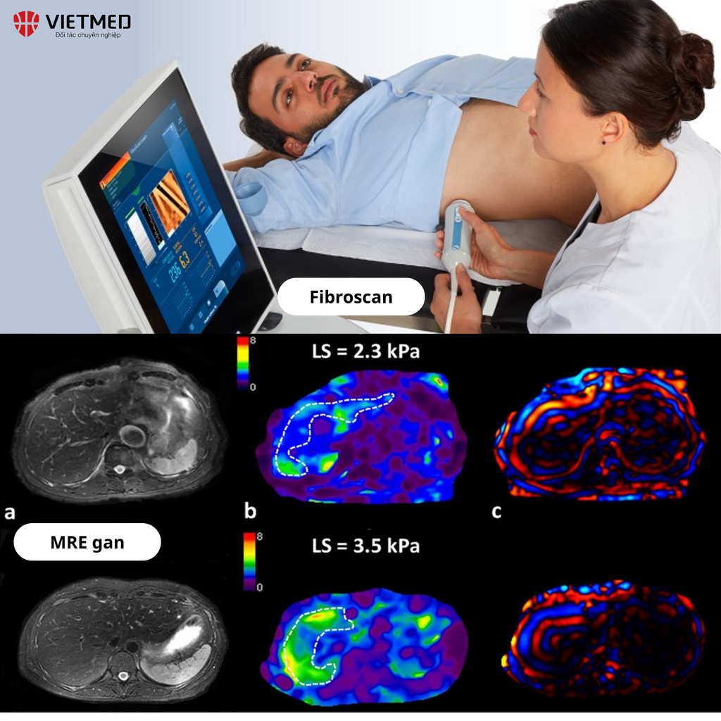 fibroscan và mre gan