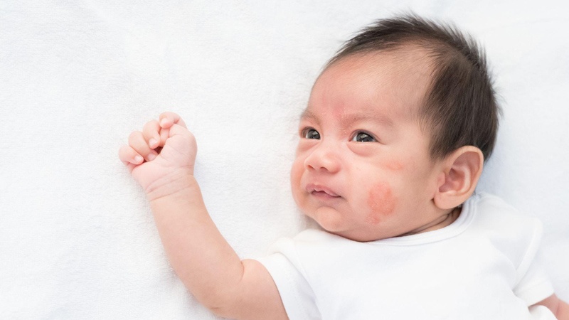 Thở khò khè hoặc khó thở là dấu hiệu của dị ứng sữa công thức