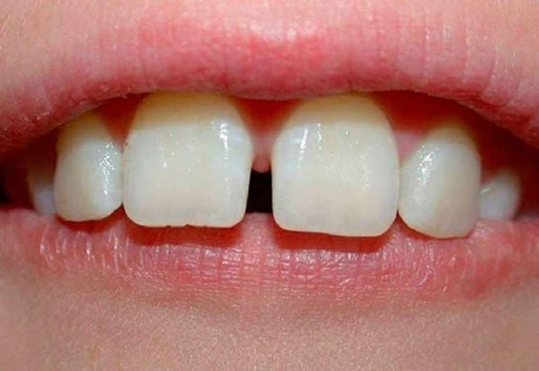 răng cửa thưa có niềng được không