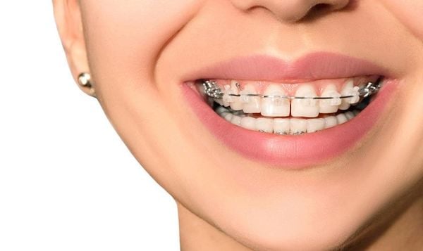 răng cửa thưa có niềng được không