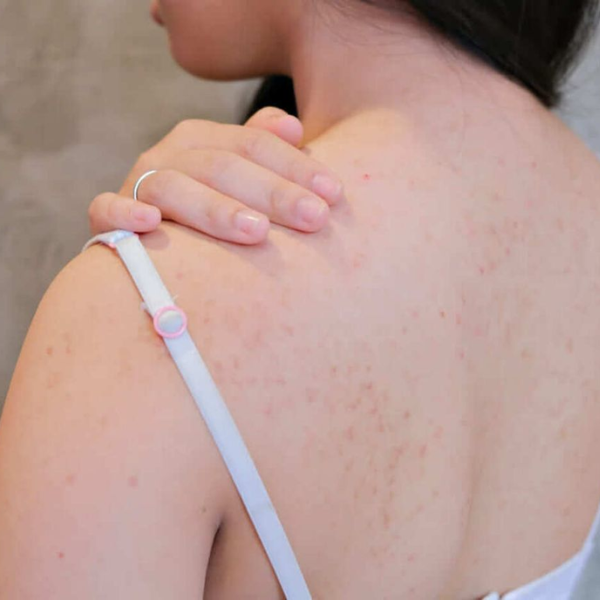 cô gái bị mụn lưng