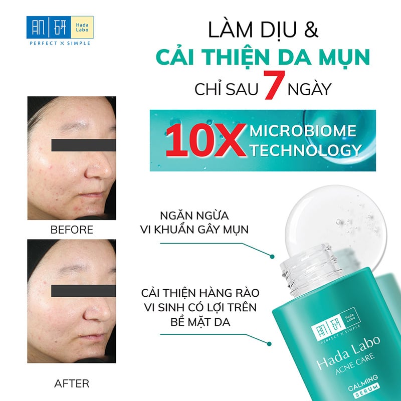 thegioiskinfood.com - Serum Dưỡng Ẩm Cho Da Mụn, Nhạy Cảm Hada Labo Acne Care Calming Serum 30ml