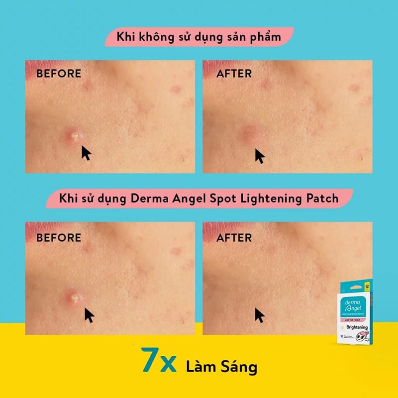 thegioiskinfood.com - Miếng Dán Mụn Mờ Thâm Sáng Da Derma Angel Spot Lightening Patch With TXA + CICA Brightening (12 miếng)