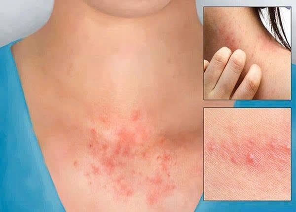 dị ứng khăn ướt