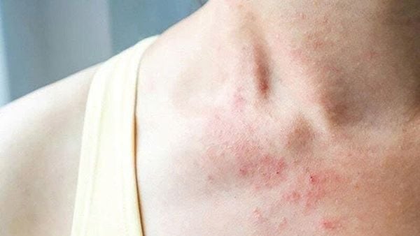 dị ứng khăn ướt
