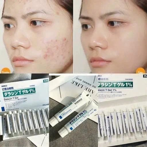 Kem Giảm Mụn Dalacinn T Gel 1% Sato Nhật Bản 10gr
