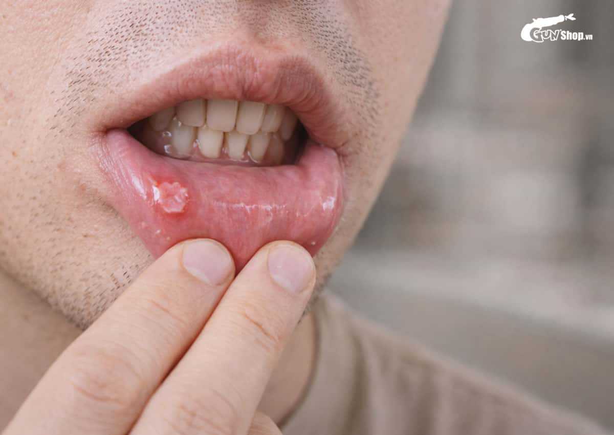 Quan hệ bằng miệng có nguy cơ lây bệnh gì?