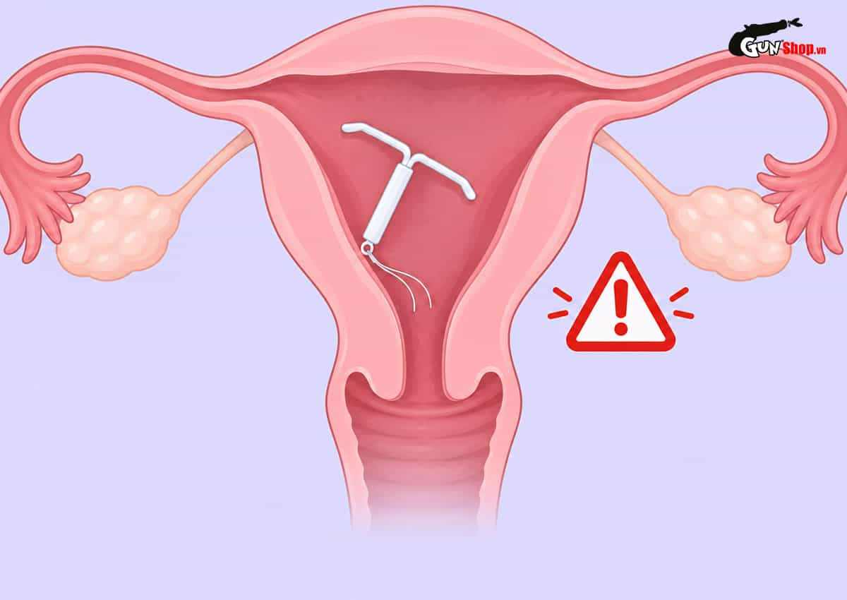 Quan hệ mạnh có ảnh hưởng đến vòng tránh thai?