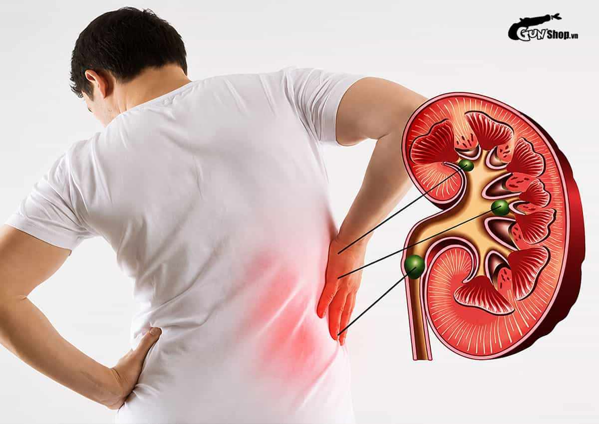Tan sỏi thận bao lâu thì quan hệ được?
