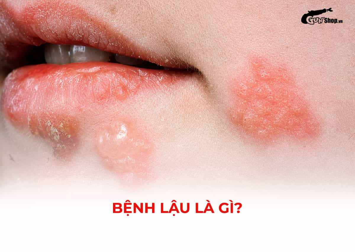 Bệnh lậu là gì? Dấu hiệu, đường lây và cách điều trị hiệu quả