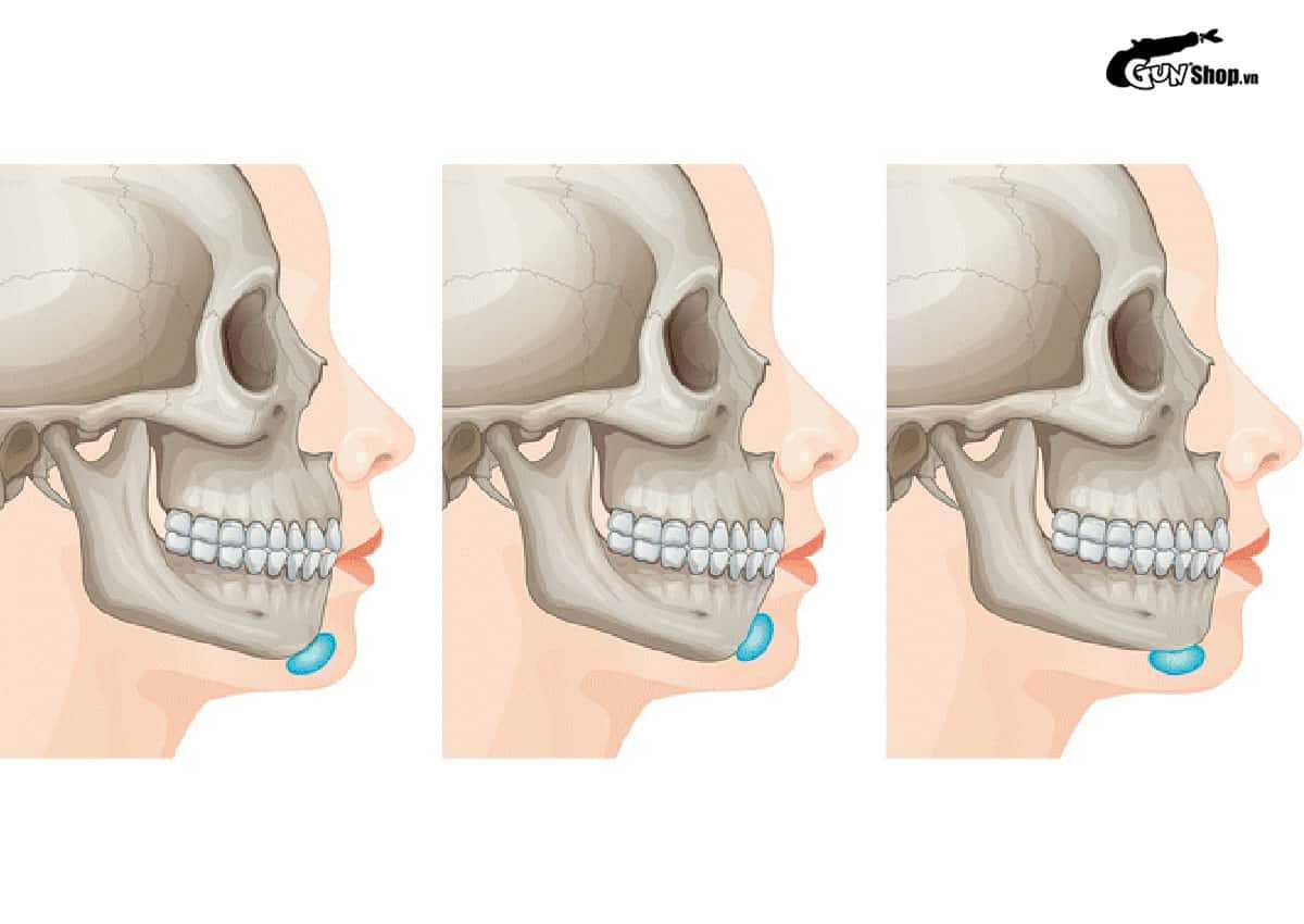 Độn cằm kiêng quan hệ bao lâu?