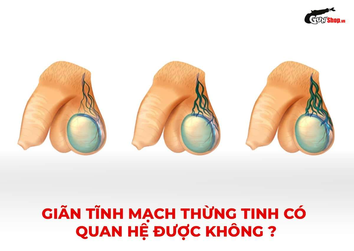 Giãn tĩnh mạch thừng tinh có quan hệ được không?