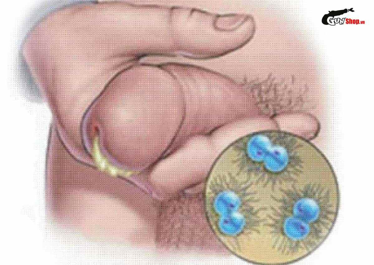 Nhiễm khuẩn đường sinh dục là gì?