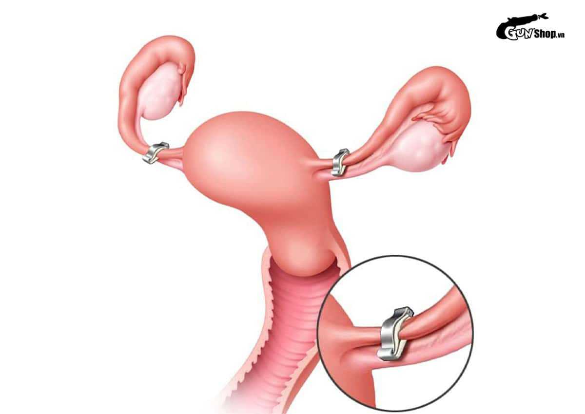 Thắt ống dẫn tinh có ảnh hưởng gì không?