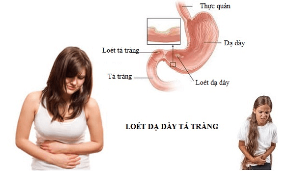 iberogast-giam-day-hoi-kho-tieu-nhap-khau-duc
