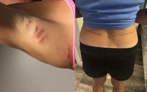 Vùng da của nữ runner bị trầy đỏ