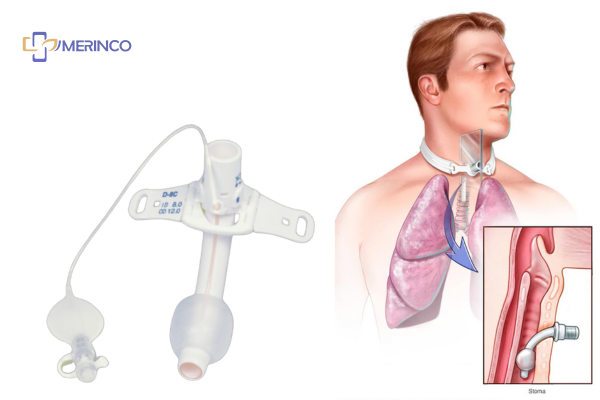 bộ mở khí quản có bóng