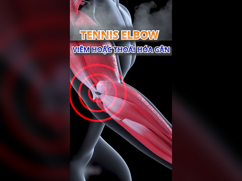 HỘI CHỨNG KHUỶU TAY TENNIS (TENNIS ELBOW)