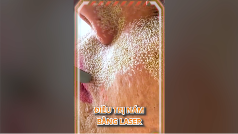ĐIỀU TRỊ NÁM BẰNG LASER CÓ NGUY HIỂM