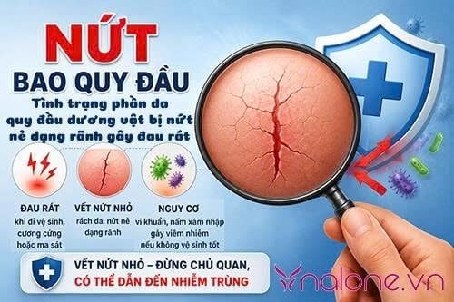 Nứt bao quy đầu là gì?