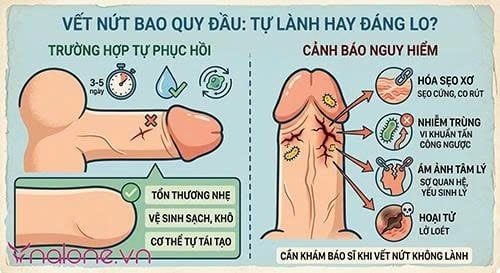 Nứt bao quy đầu là gì?
