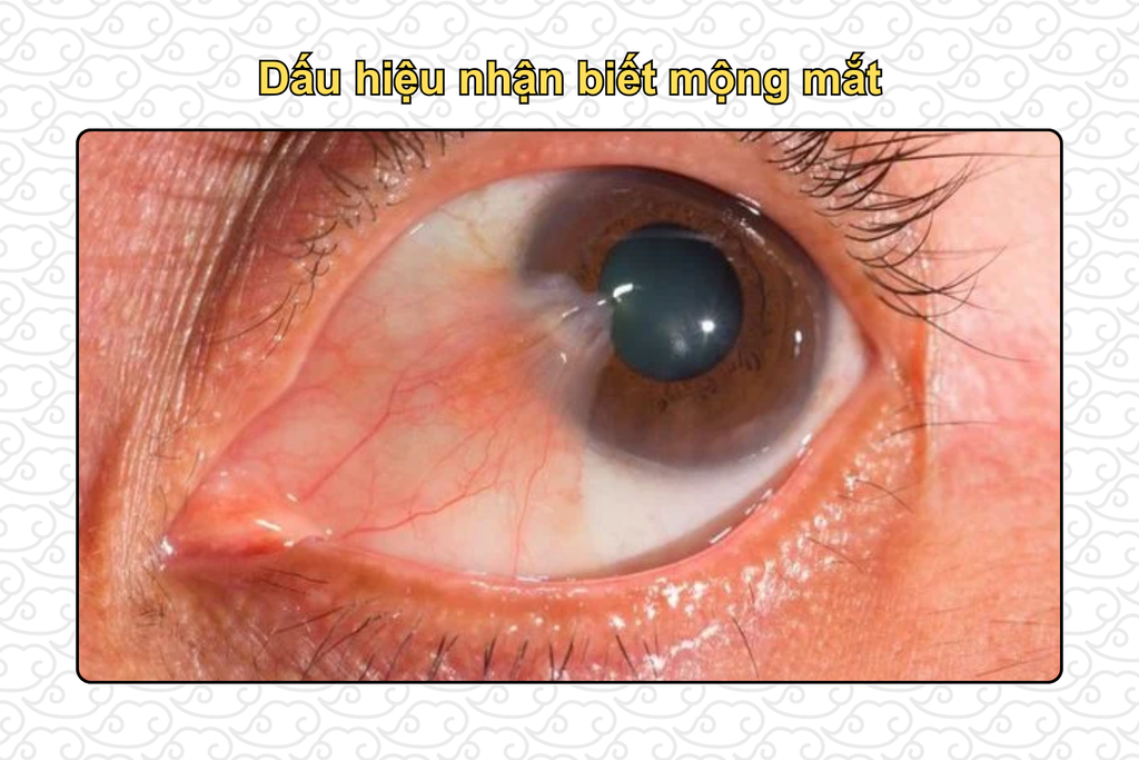 dau-hieu-nhan-biet-mong-mat