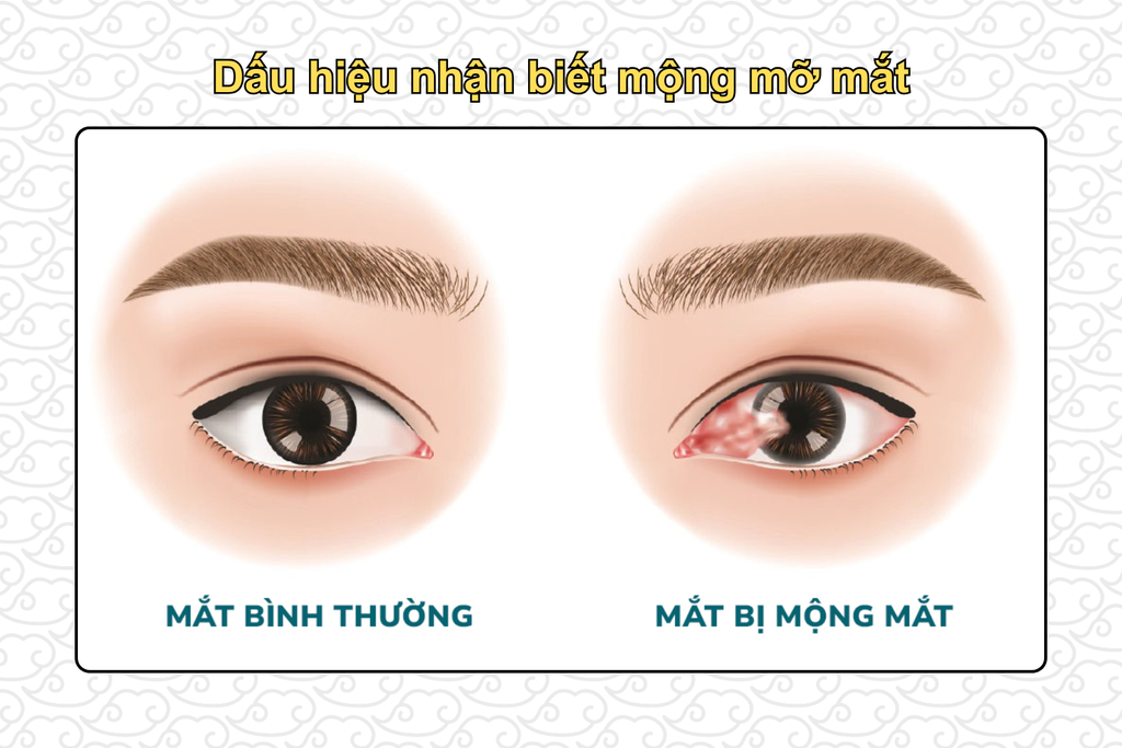 dau-hieu-nhan-biet-mong-mo-mat