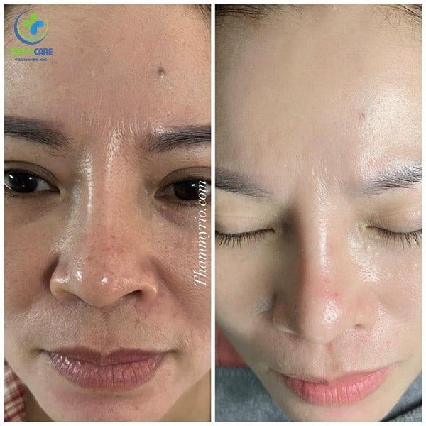 So sánh diện mạo chính diện Trước và Sau khi làm sạch các đốm sắc tố li ti trên da tại địa chỉ trị nám uy tín