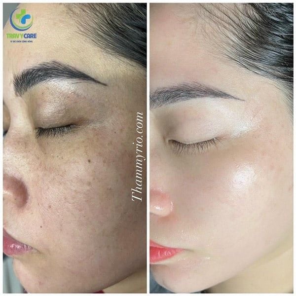 Cận cảnh góc nghiêng nửa mặt trước và sau khi làm mờ mảng sắc tố đậm màu tại địa chỉ trị nám uy tín