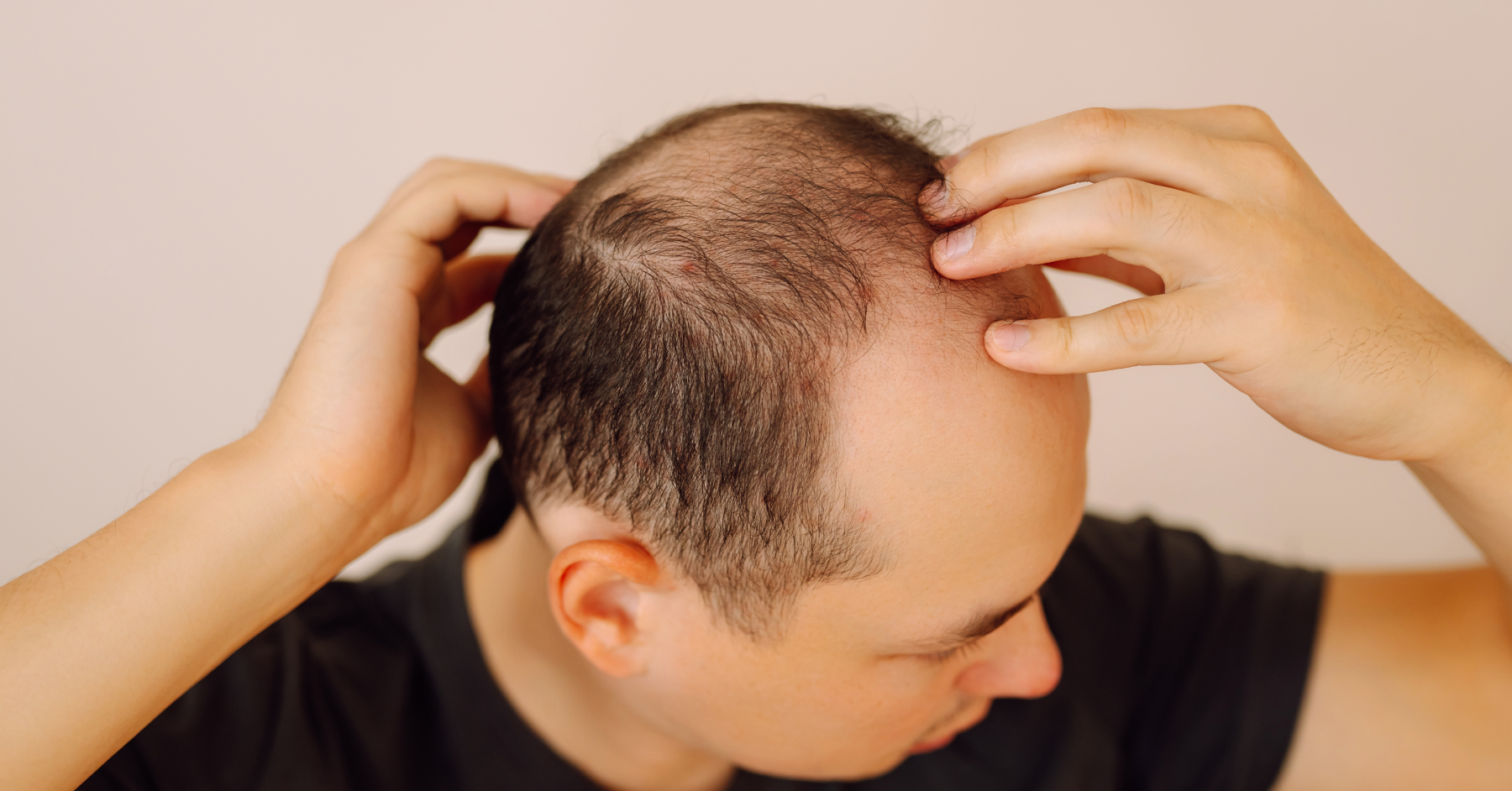 Vì sao nam giới tuổi 40 dễ rụng tóc hơn?