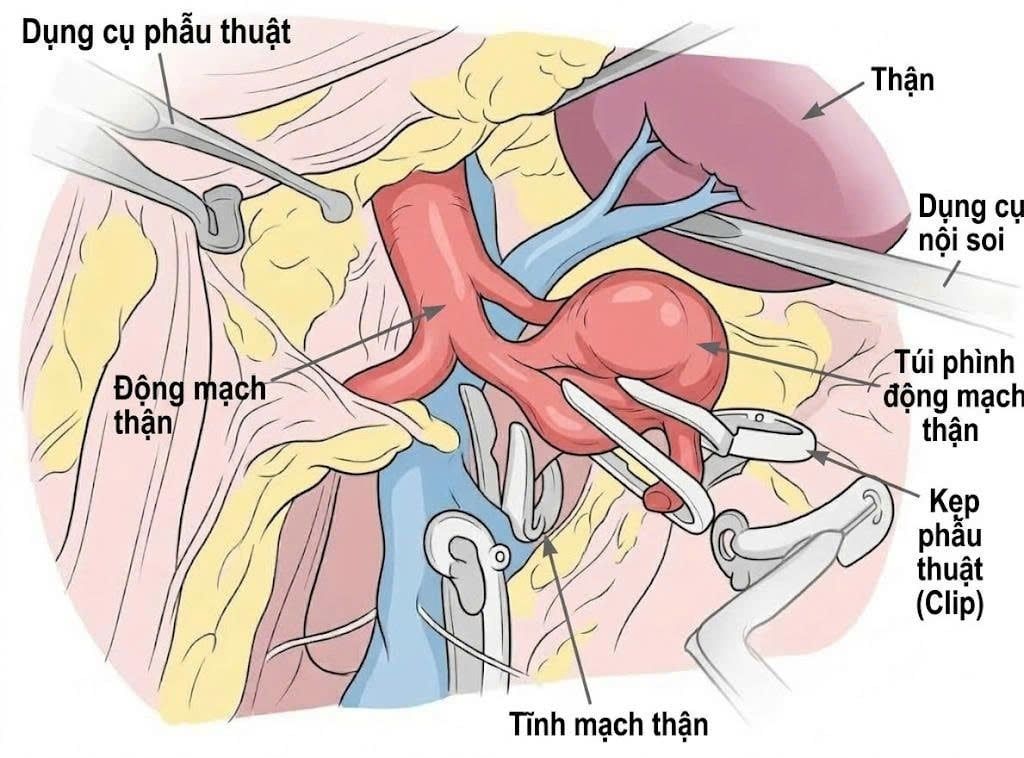 PHẪU THUẬT NỘI SOI XỬ LÝ THÀNH CÔNG TÚI PHÌNH ĐỘNG MẠCH THẬN