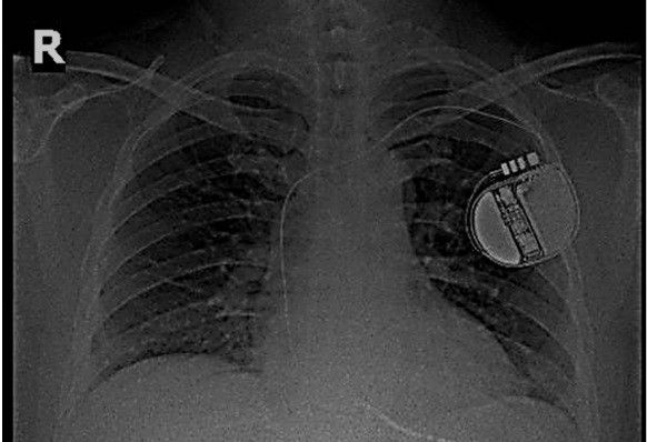 Thoát khỏi tử thần nhờ thiết bị phá rung tim cấy ghép trong cơ thể