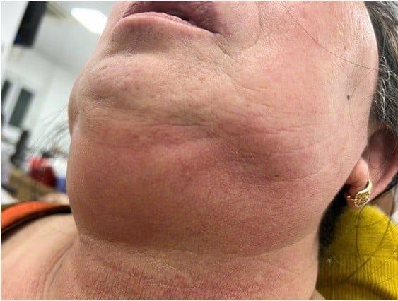 Nguy cơ nhiễm trùng răng miệng trên người bệnh đái tháo đường