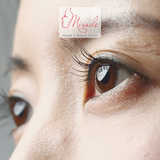 Cắt Mỡ Mí Mắt Trên