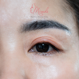 Sụp Mi Mắt: Nguyên Nhân Và Cách Điều Trị